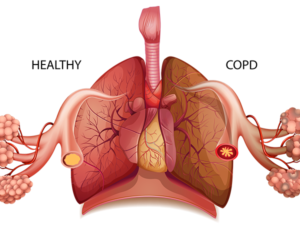 copd silica dust